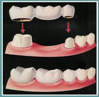 Dental Crowns & Bridges at Supreme Multi-Speciality Dental Centre
