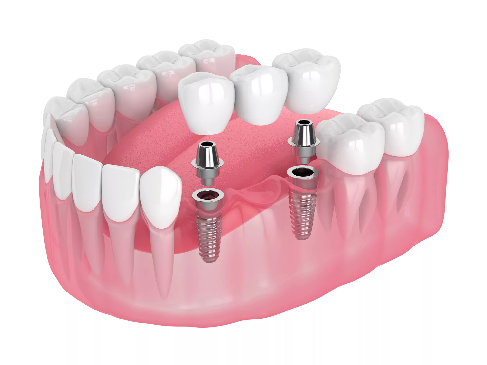 Dental Crowns & Bridges at Supreme Multi-Speciality Dental Centre