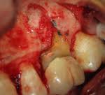 Gum Disease Treatment at Supreme Multi-Speciality Dental Centre