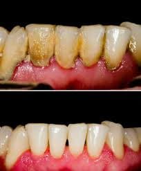 Gum Disease Treatment at Supreme Multi-Speciality Dental Centre