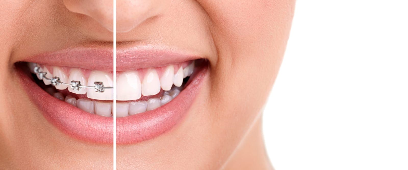 Orthodontics — Braces & Aligners at Supreme Multi-Speciality Dental Centre