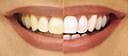 Confident smile after orthodontic treatment