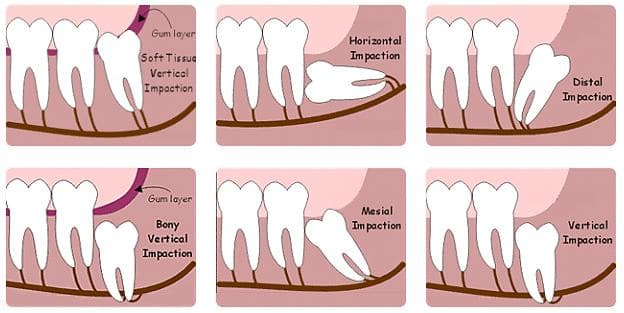 Impacted Wisdom Tooth Removal at Supreme Multi-Speciality Dental Centre