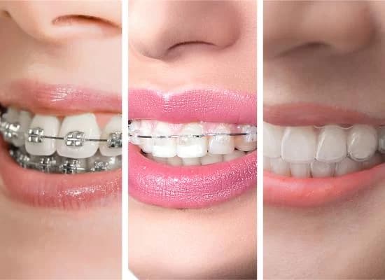 Orthodontics — Braces & Aligners at Supreme Multi-Speciality Dental Centre