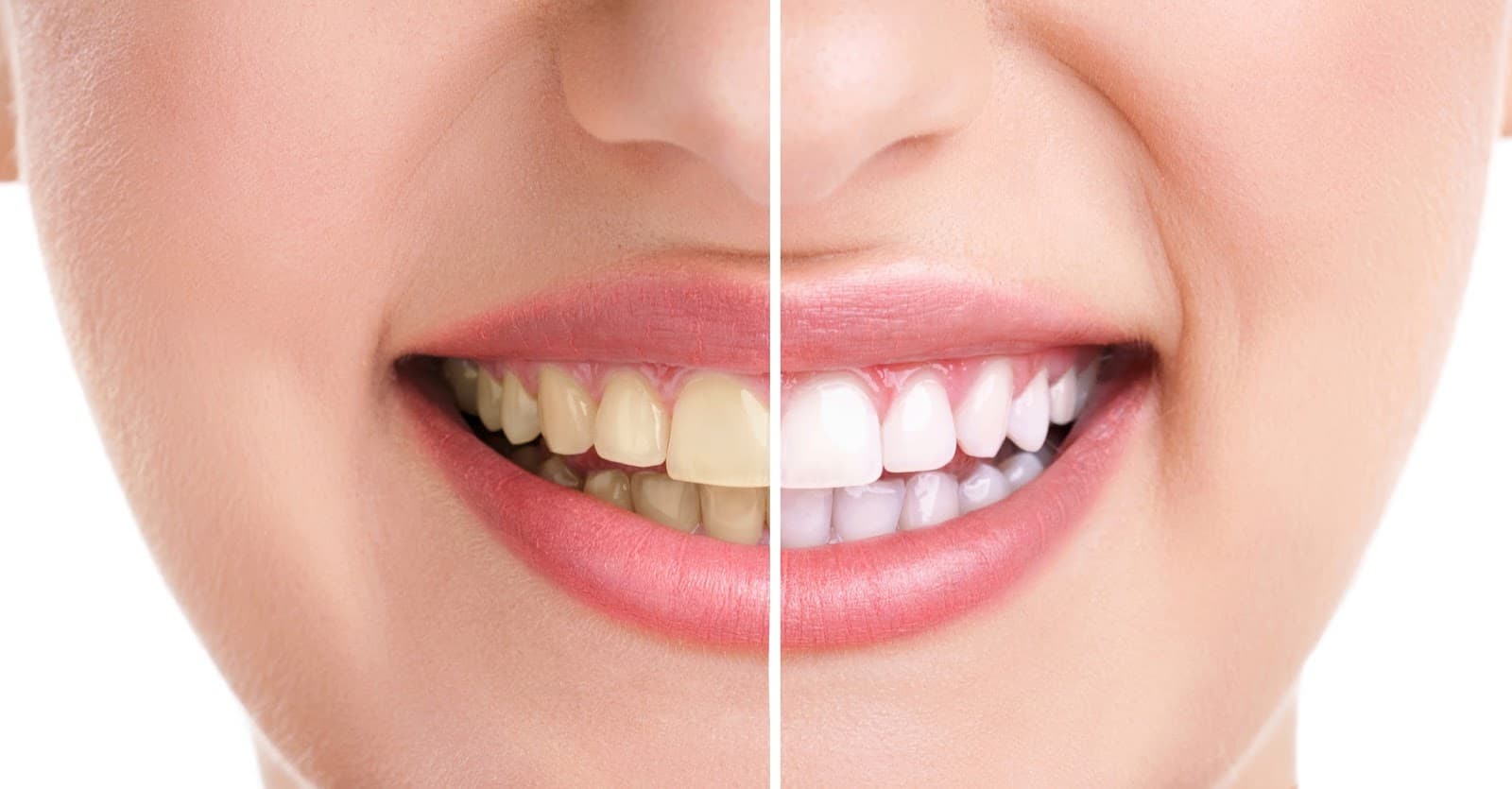 Teeth Whitening & Bleaching at Supreme Multi-Speciality Dental Centre