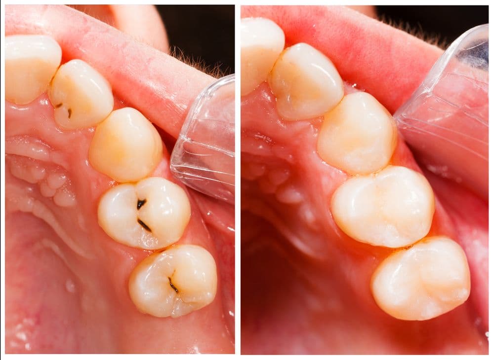 Tooth Filling at Supreme Multi-Speciality Dental Centre