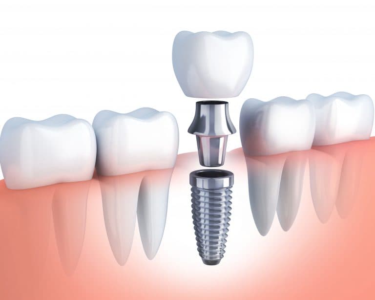 Dental Implants at Supreme Multi-Speciality Dental Centre