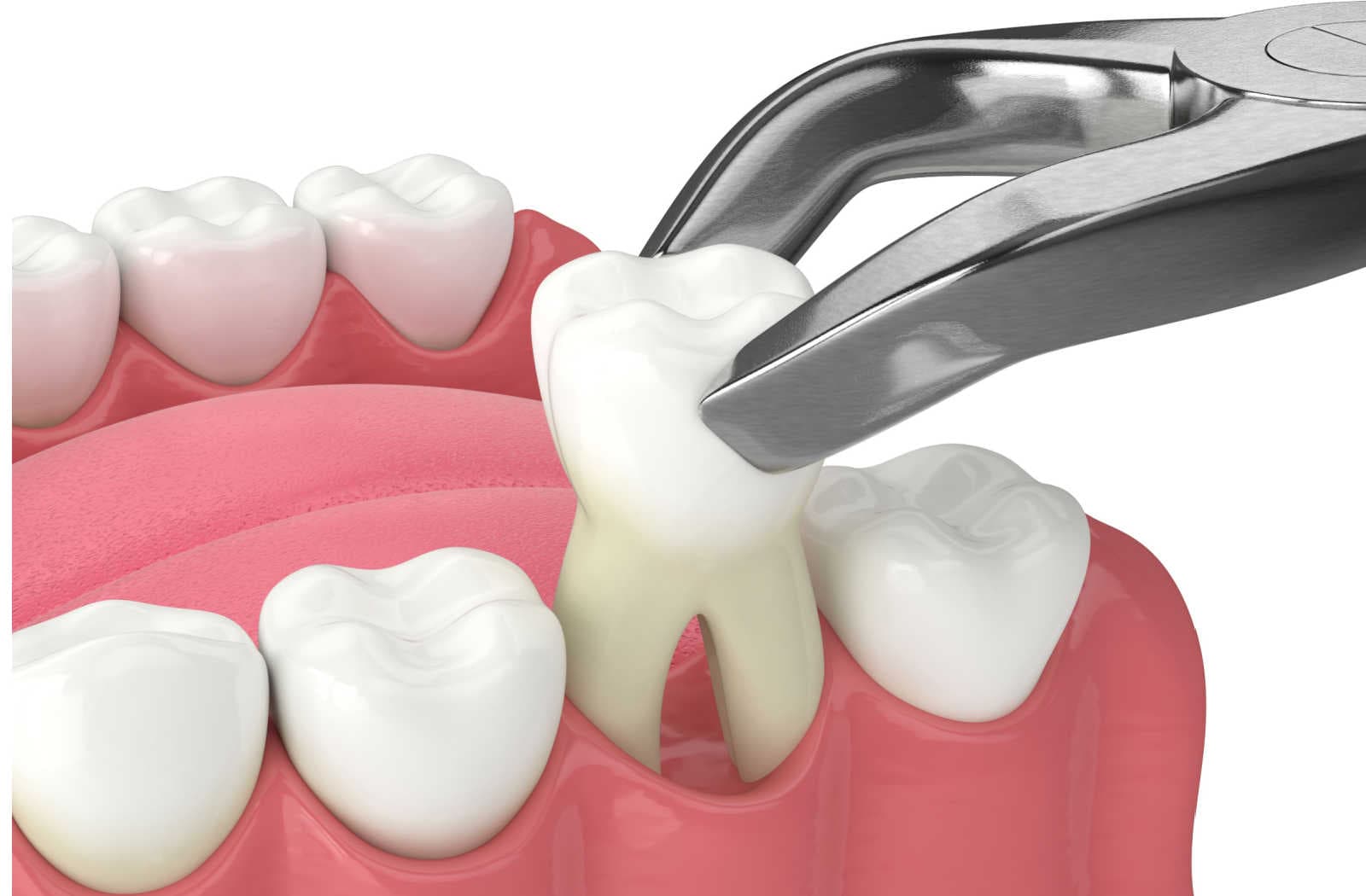 Tooth Extraction at Supreme Multi-Speciality Dental Centre